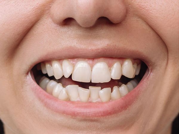 Before orthodontic treatment